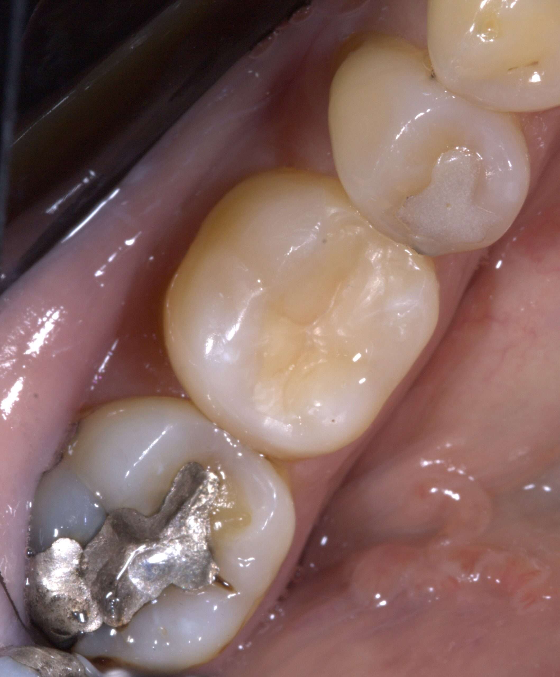 Filling or Extraction? What to Do When a Tooth Can’t Be Saved ...