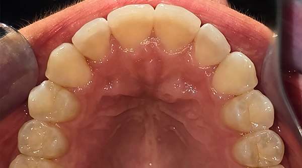 Case 1 - Invisalign® After