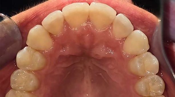Case 1 - Invisalign® After