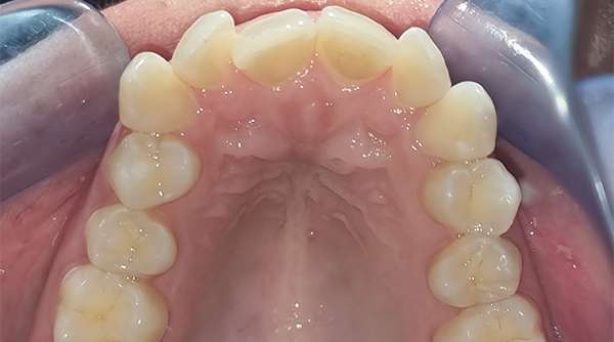 Case 1 - Invisalign® Before