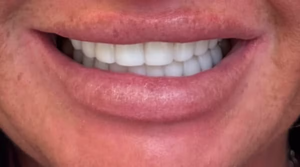 Case 40 - composite bonding - after