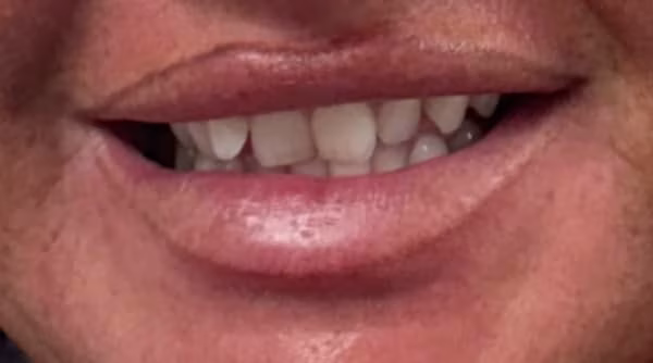 Case 40 - composite bonding - before