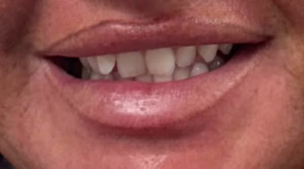 Case 40 - composite bonding - before