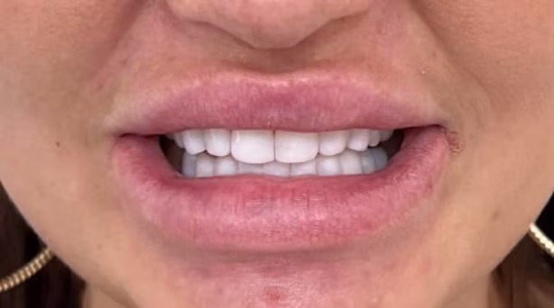 Case 41 - composite bonding - after