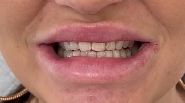 Case 41 - composite bonding - before