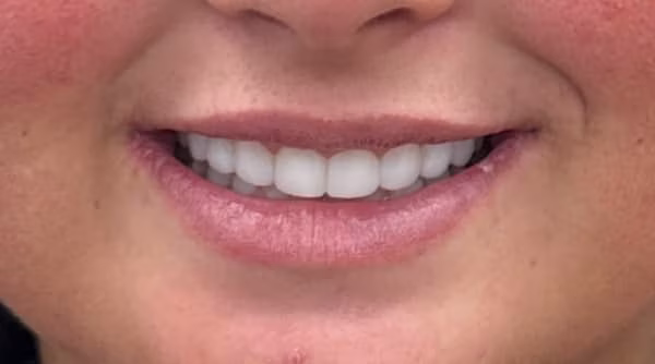 Case 42 - composite bonding - after