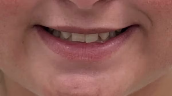 Case 42 - composite bonding - before