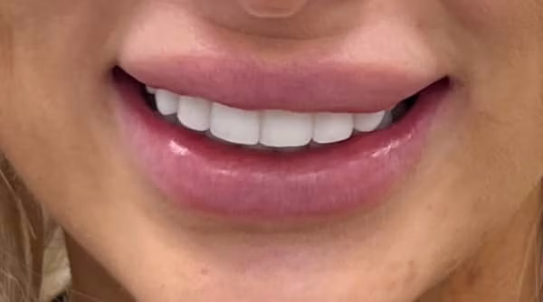 Case 43 - composite bonding - after
