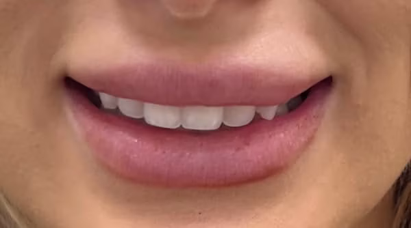 Case 43 - composite bonding - before