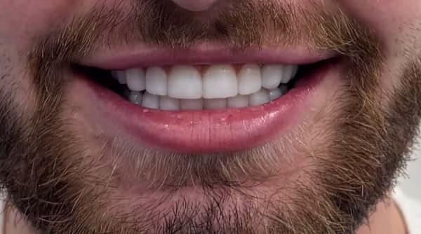 Case 44 - composite bonding - after