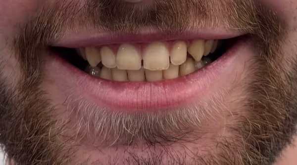 Case 44 - composite bonding - before