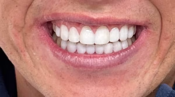 Case 45 - composite bonding - after