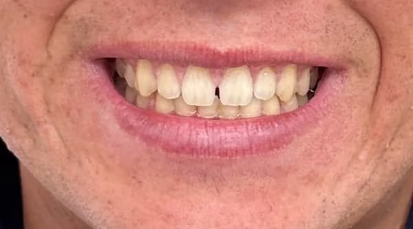 Case 45 - composite bonding - before