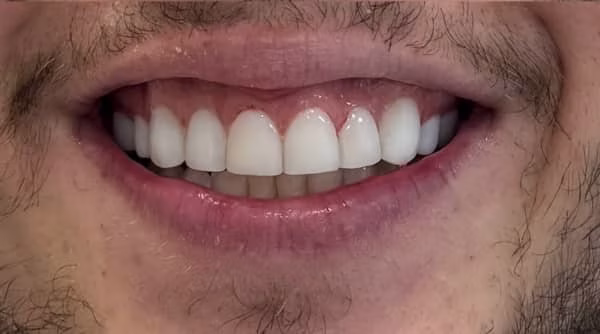 Case 46 - composite bonding - after