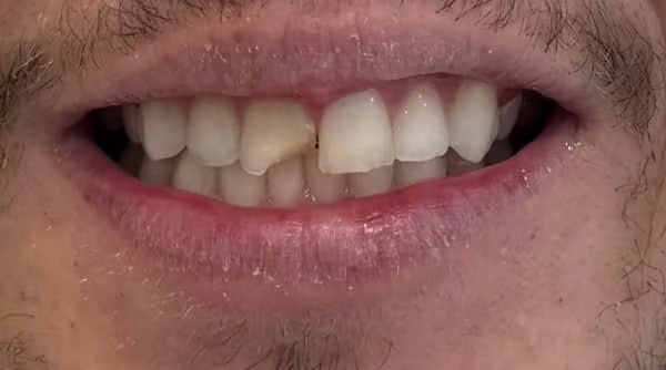 Case 46 - composite bonding - before