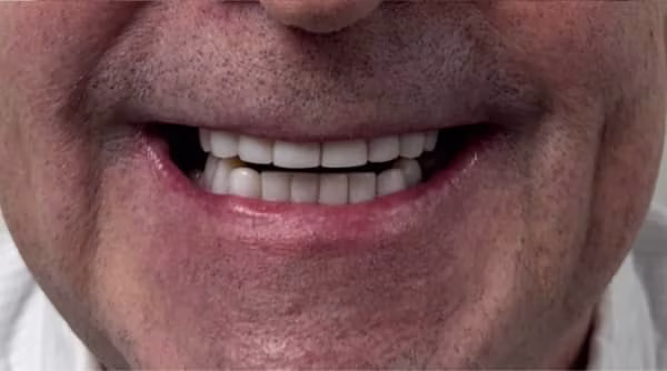 Case 47 - composite bonding - after