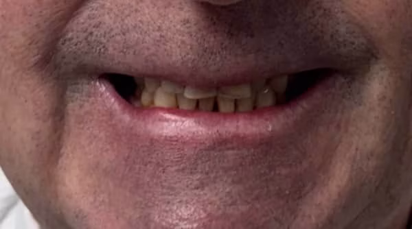 Case 47 - composite bonding - before