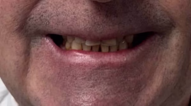 Case 47 - composite bonding - before