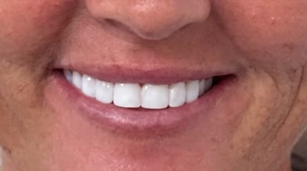 Case 48 - composite bonding - after