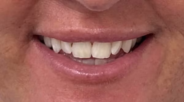 Case 48 - composite bonding - before