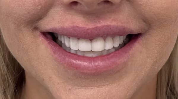 Case 49 - composite bonding - after