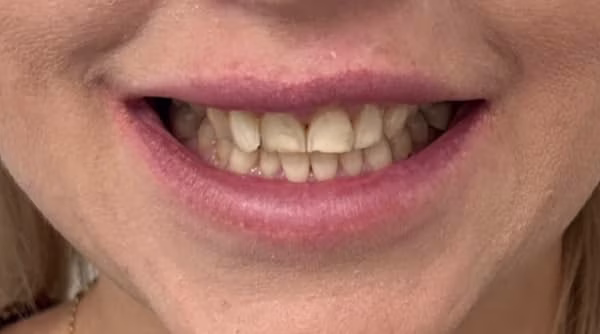 Case 49 - composite bonding - before