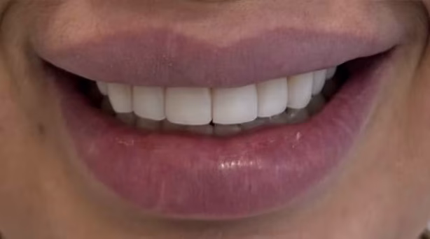 Case 50 - composite bonding - after
