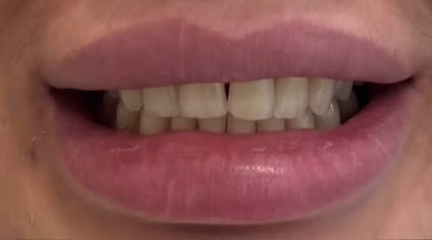 Case 50 - composite bonding - before