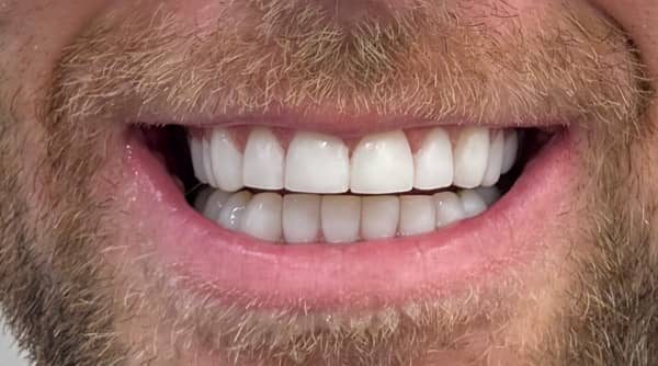 Case 51 - composite bonding - after