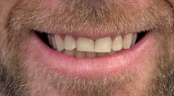 Case 51 - composite bonding - before
