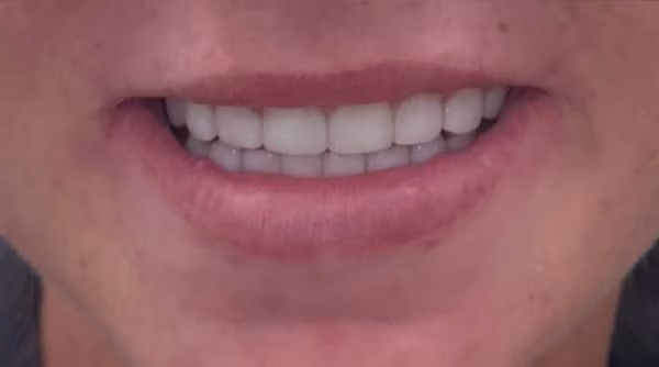 Case 52 - composite bonding - after