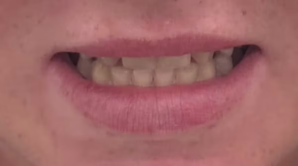Case 52 - composite bonding - before