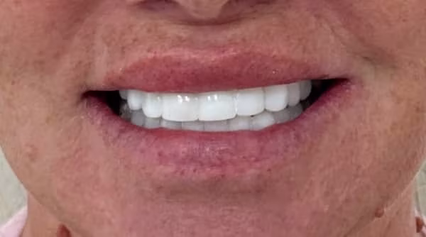 Case 53 - composite bonding - after