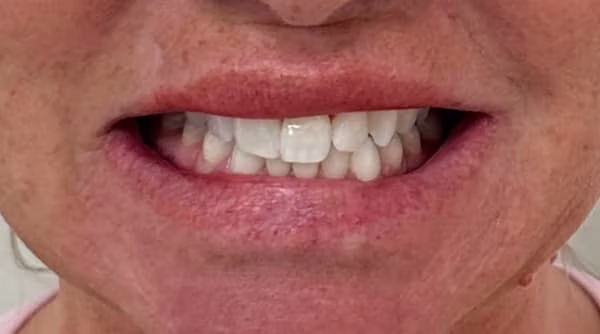 Case 53 - composite bonding - before
