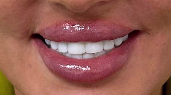 Case 54 - composite bonding - after