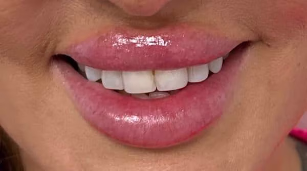 Case 54 - composite bonding - before