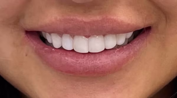 Case 55 - composite bonding - after