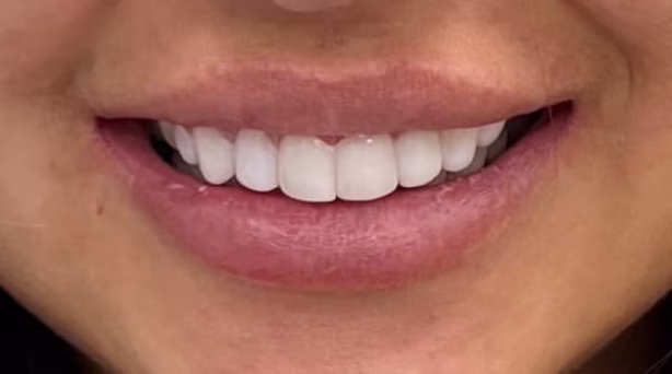 Case 55 - composite bonding - after