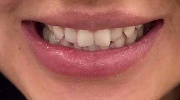 Case 55 - composite bonding - before