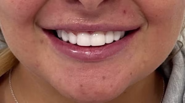 Case 56 - composite bonding - after