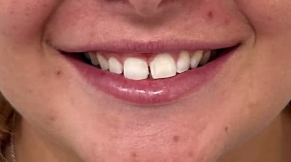 Case 56 - composite bonding - before
