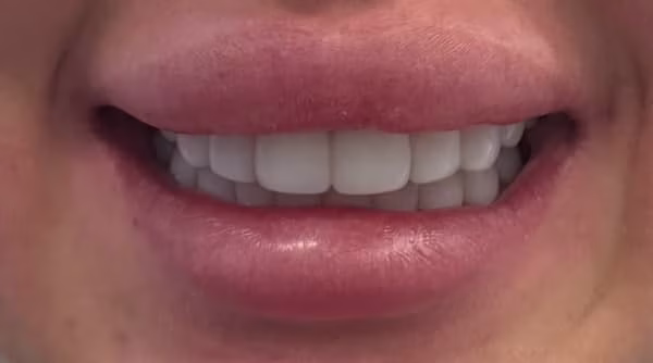 Case 57 - composite bonding - after
