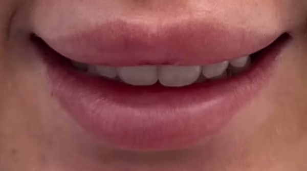 Case 57 - composite bonding - before