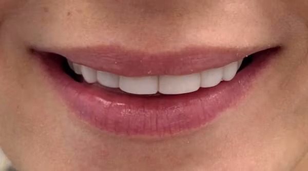 Case 58 - composite bonding - after