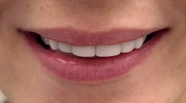 Case 58 - composite bonding - after