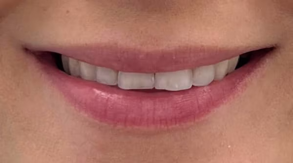 Case 58 - composite bonding - before
