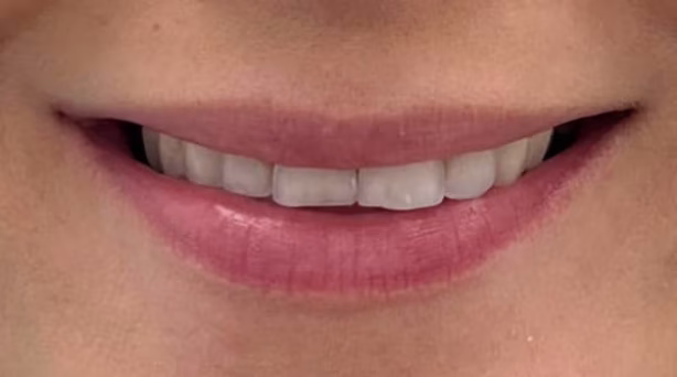 Case 58 - composite bonding - before