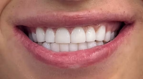 Case 59 - composite bonding - after