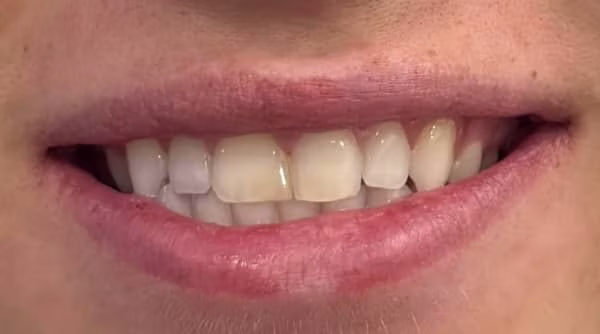 Case 59 - composite bonding - before