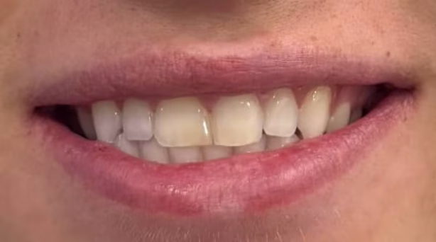 Case 59 - composite bonding - before